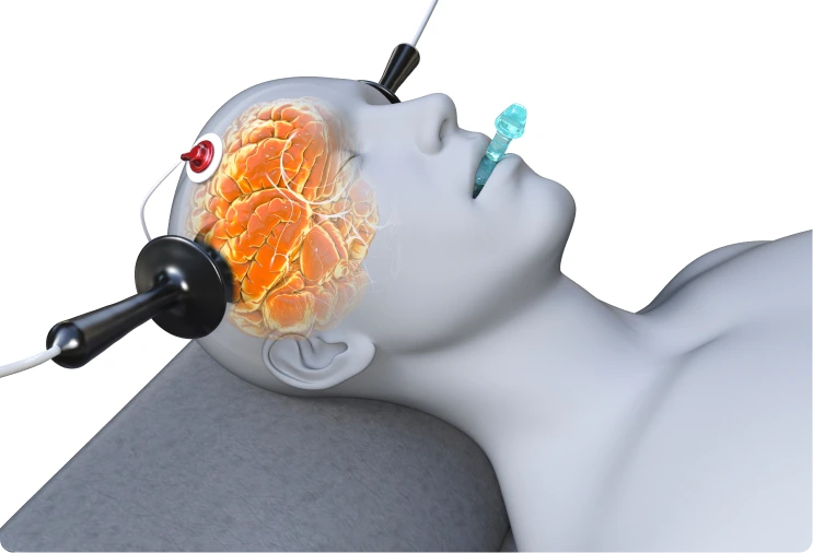 What Is Electroconvulsive Therapy? Banner