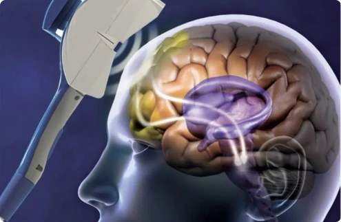What Is Transcranial Magnetic Stimulation